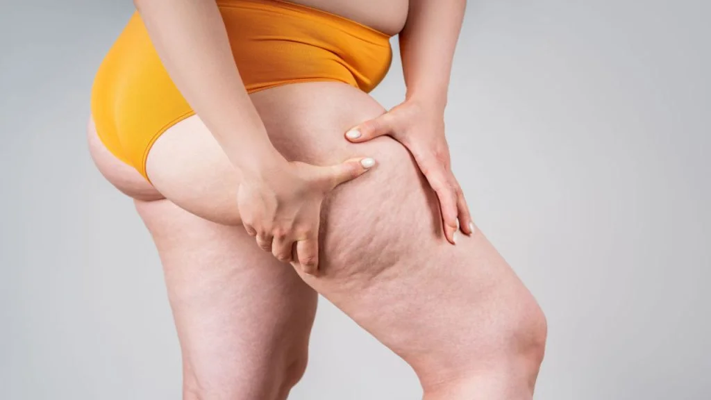 Alimentação no Lipedema: o que a ciência já sabe
